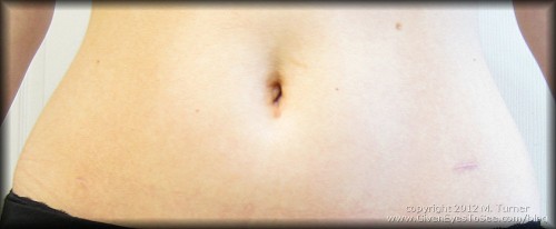 photo of healing incisions 16 weeks post op hysterectomy TLH