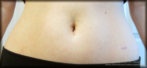 12 weeks post op hysterectomy tummy abdomen healing incisions