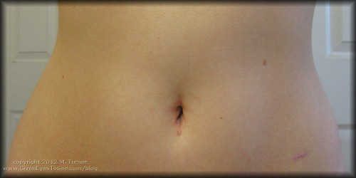 Photo of stomach and healing scars 6 months after a hysterectomy