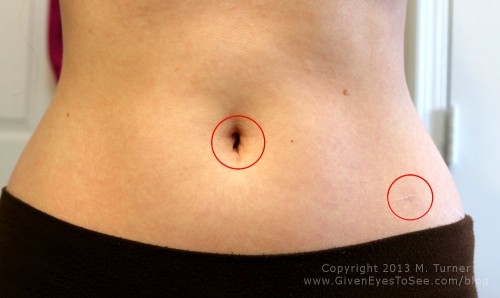 My Total Laparoscopic Hysterectomy (TLH) scars two years post-op.