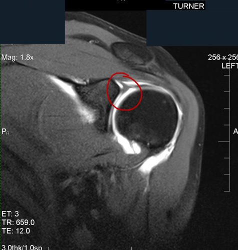 MRI arthrogram slap tear; Left superior labral tear extending along the posterior superior quadrant.