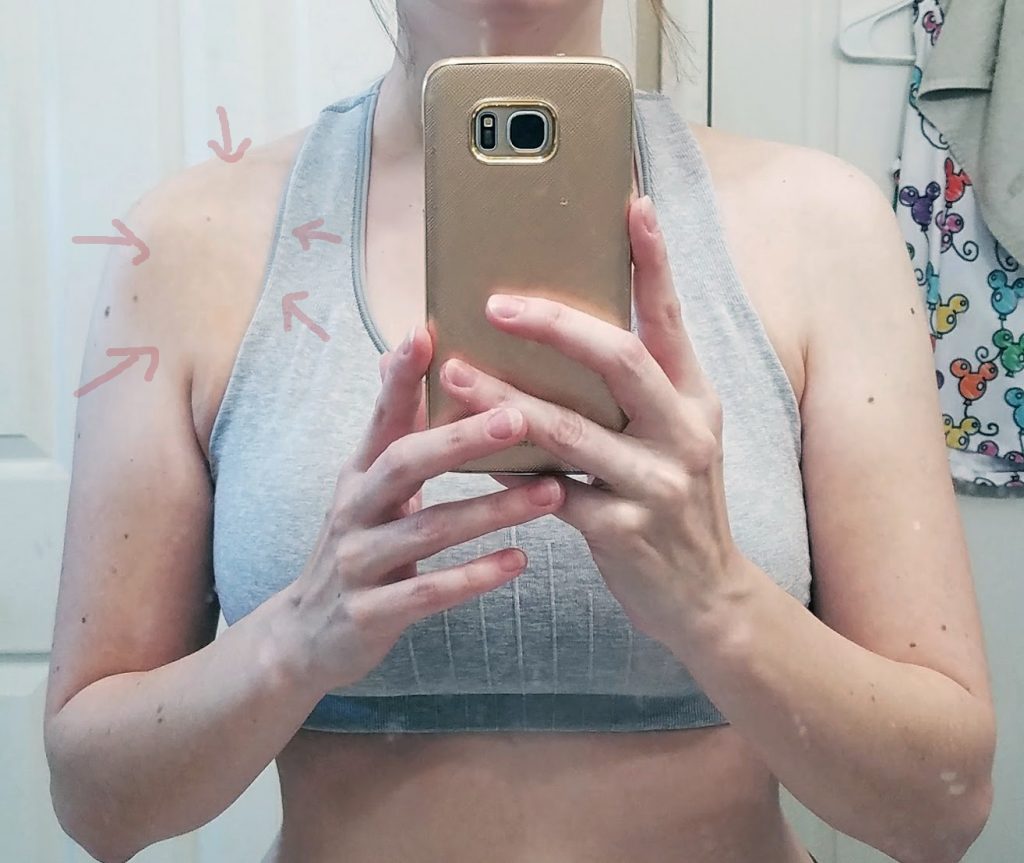 My MRI Arthrogram Experience Given Eyes To See